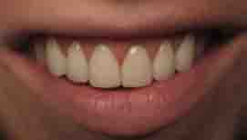 Dentcmu เหงือกคุณแค่ไหน