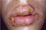 Herpes